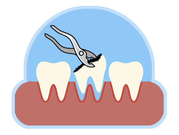  Удаление зубов